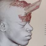実際の頭蓋骨損傷の3D画像（Foto: Divulgação）